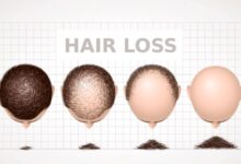 4 Factors of Hair Loss in Men