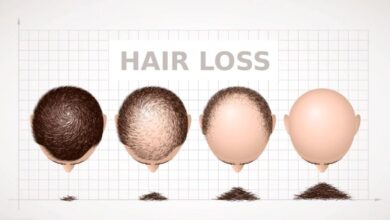 4 Factors of Hair Loss in Men