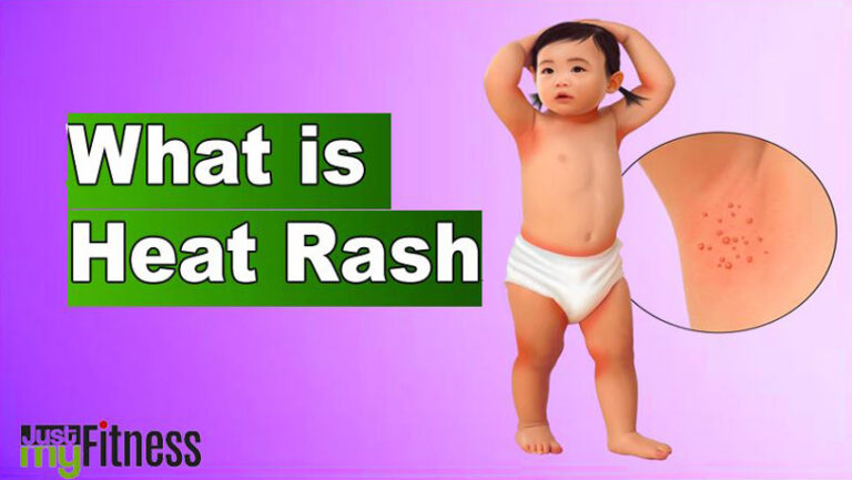 What is Heat Rash