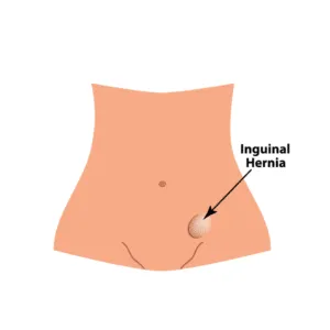 Inguinal Hernia